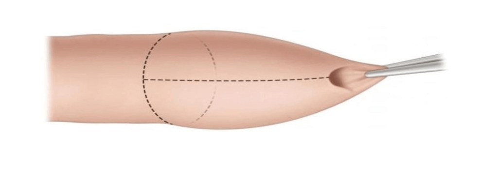 Beschneidung - Vorhaut